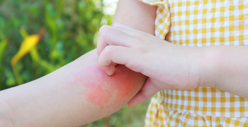 Фото - Алергія у дітей: види, симптоми, причини та сучасний підхід до діагностики