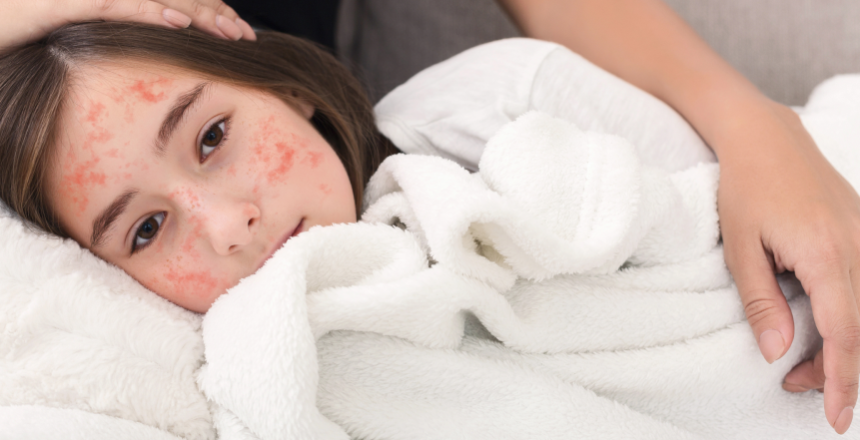 Фото - Кір у дорослих та дітей: від симптомів до лікування