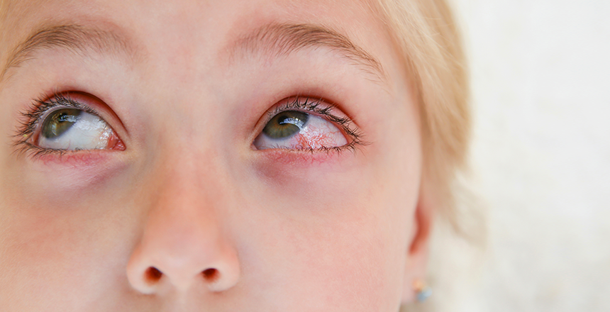 кон'юктивіт у дітей