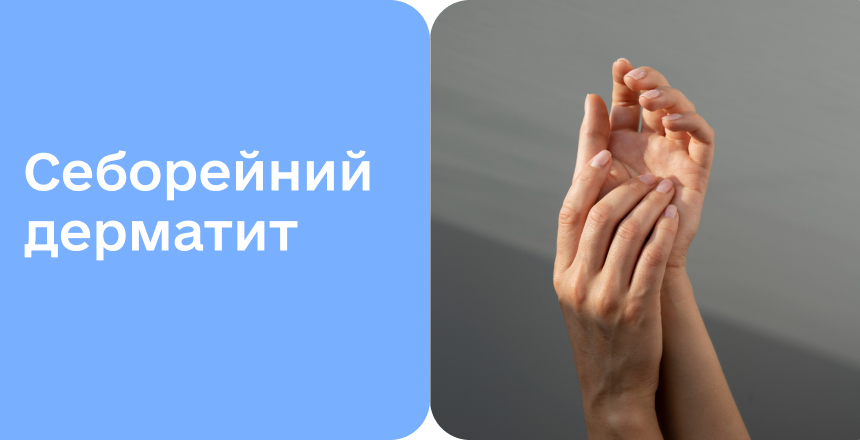 Фото - Себорейний дерматит: від причин до лікування