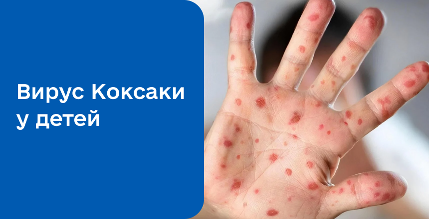 Фото - Коксаки у детей: симптомы, лечение и фотографии сыпи