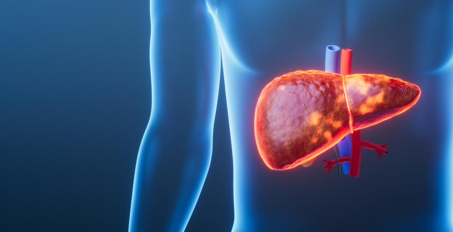 Фото - МАСБП и МетАБП: новая терминология, лабораторная диагностика и анализ клинического случая