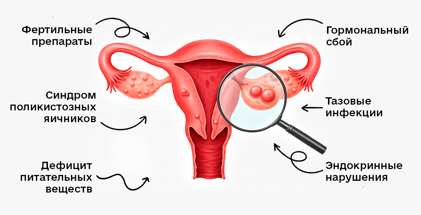 причины возникновения кисты яичника