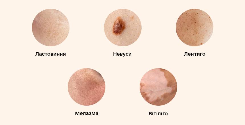 види гіперпігментації 